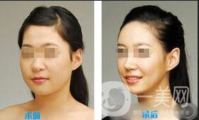 深圳臉部抽脂多少錢