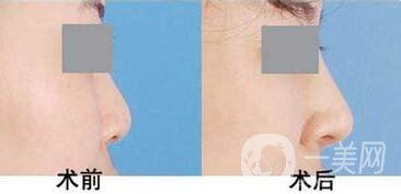 上海駝峰鼻矯正價(jià)錢