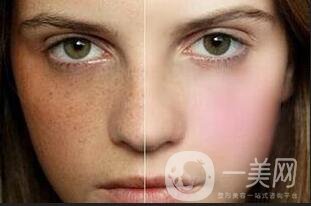 激光去黃褐斑術(shù)后護(hù)理