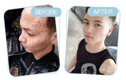 像素激光祛痘坑術(shù)后護(hù)理工作主要做些什么