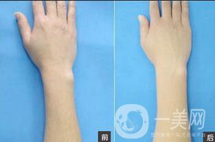 深圳光子脫毛收費(fèi)