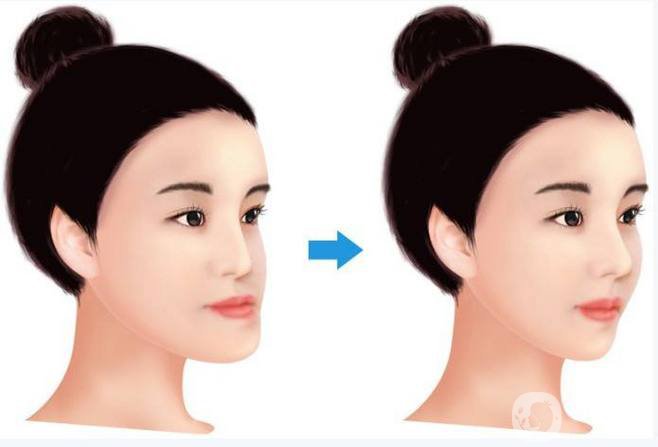 地包天矯正報價