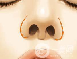 鼻翼縮小手術價錢 