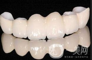貴金屬烤瓷牙,全瓷牙