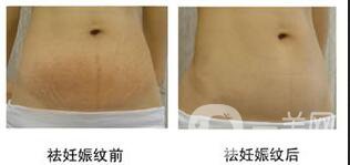 去妊娠紋價(jià)格