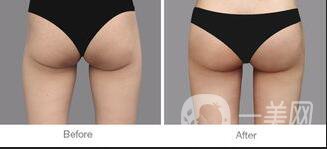 自體脂肪豐臀,價(jià)格