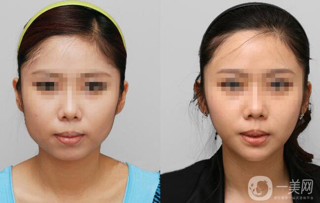 超聲法瘦臉報價 