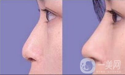 鼻翼縮小費(fèi)用,鼻翼縮小多少錢(qián)