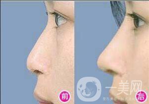 玻尿酸隆鼻多少錢