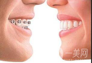 上顎整形報(bào)價(jià)