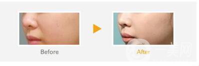 上顎整形報(bào)價(jià)