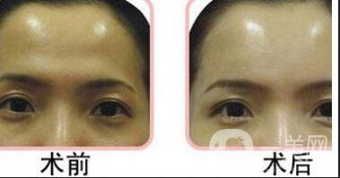 膠原蛋白豐額頭報價