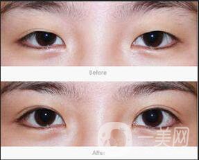 割雙眼皮術(shù)前檢查