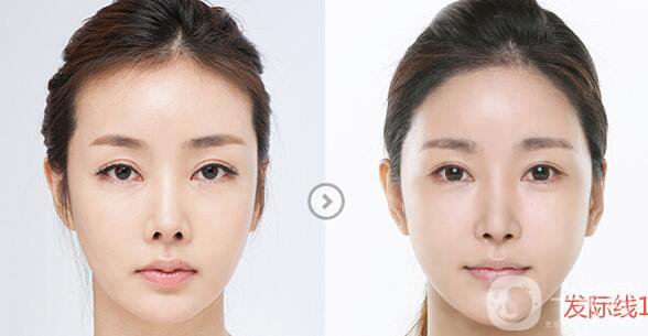 頭發(fā)種植,頭發(fā)種植術(shù)后護(hù)理