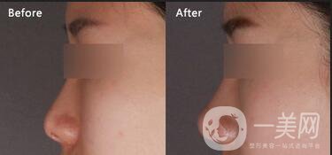 隆鼻整容費(fèi)用