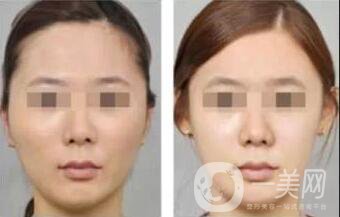 玻尿酸豐面頰多少錢