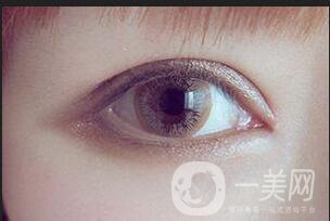 溶脂去眼袋修復(fù)價格