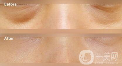 溶脂去眼袋修復(fù)價格