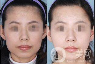 去下頜角多少錢,北京去下頜角多少錢,去下頜角