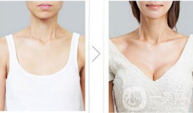 脂肪隆胸整形手術價格