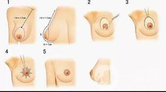 乳頭整形價(jià)格,乳頭整形
