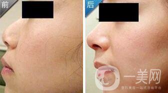 玻尿酸隆鼻價(jià)格