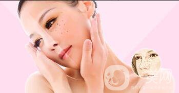 祛斑價錢,激光祛斑價格