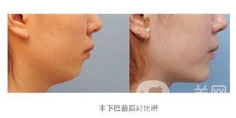 玻尿酸豐下巴報價