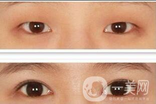 雙眼皮貴不貴,雙眼皮價(jià)格