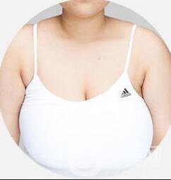 巨乳縮小術(shù)貴嗎,巨乳縮小多少錢