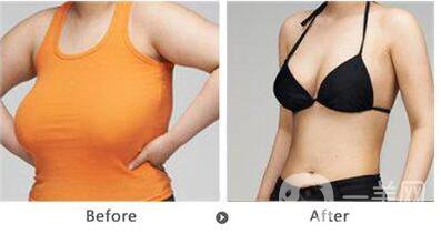 巨乳縮小術(shù)貴嗎,巨乳縮小多少錢