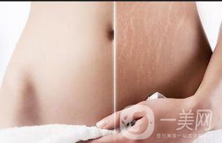 去妊娠紋價(jià)格