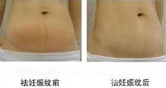 去妊娠紋價(jià)格