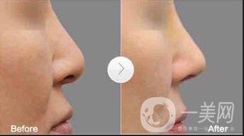 假體隆鼻多少錢(qián)