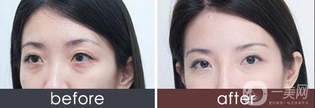 玻尿酸填充淚溝價格