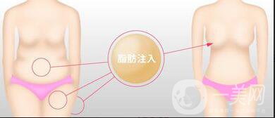 吸脂隆胸整形手術(shù)價(jià)格