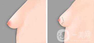 乳房下垂矯正貴嗎,乳房下垂矯正多少錢