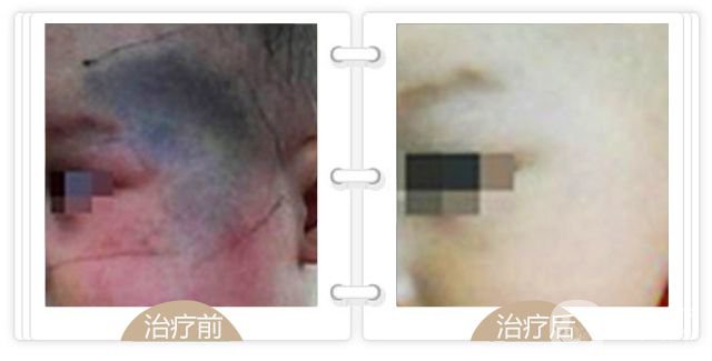 上海去青色胎記多少錢