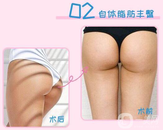 上海自體脂肪填屁股多少錢(qián)