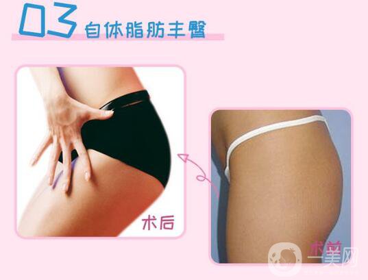 上海自體脂肪填屁股多少錢(qián)