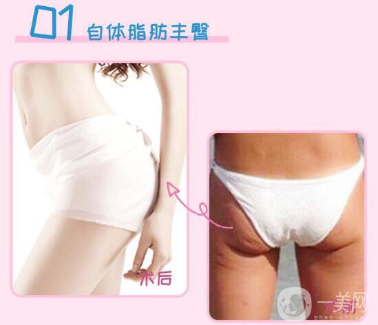 上海自體脂肪填屁股多少錢(qián)