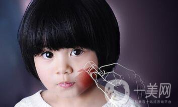 深圳激光去胎記多少錢