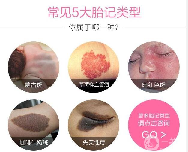 深圳激光去胎記多少錢