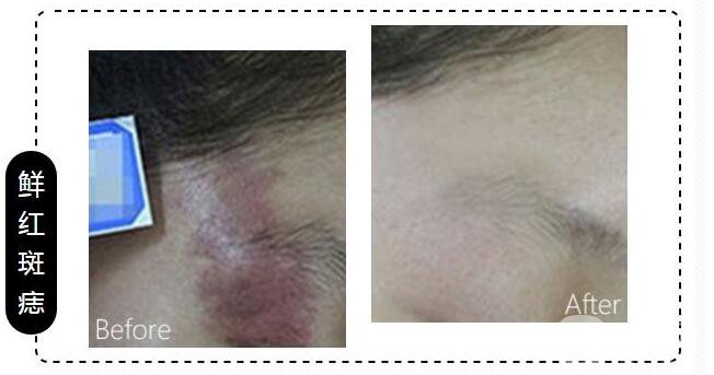 深圳去紅色胎記收費(fèi)標(biāo)準(zhǔn)