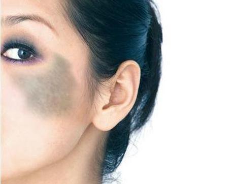 深圳去青色胎記多少錢