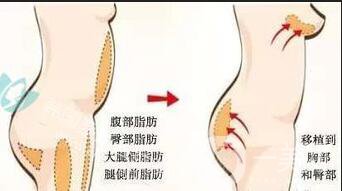 深圳自體脂肪豐臀價(jià)格,自體脂肪豐臀價(jià)格,自體脂肪豐臀