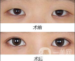 雙眼皮,開眼角,雙眼皮開眼角手術(shù)費(fèi)用