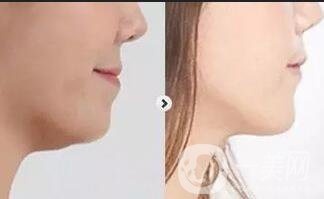 太原光纖溶脂去雙下巴多少錢,光纖溶脂去雙下巴