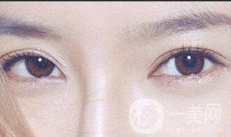 西安開眼角手術(shù)價(jià)格,開眼角價(jià)格