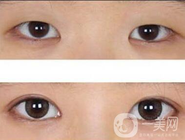 西安開眼角手術(shù)價(jià)格,開眼角價(jià)格